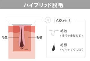 ハイブリッド脱毛の説明