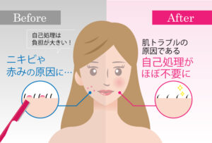 顔脱毛の効果-肌トラブル防止