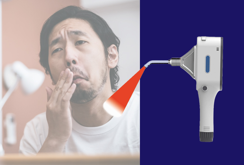 鼻毛脱毛アタッチメント
