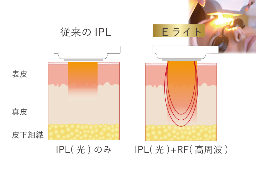 Eライトがおすすめ