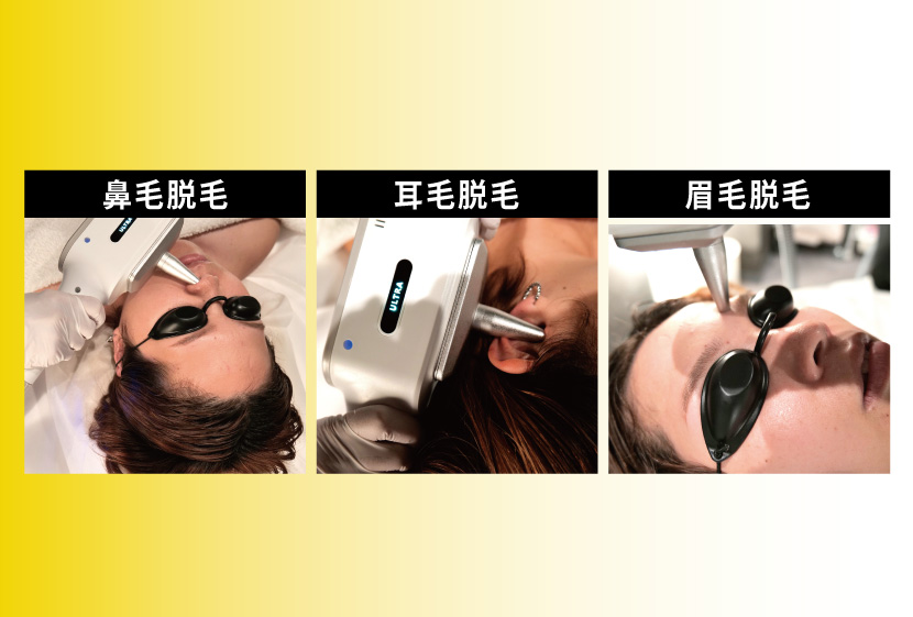 耳毛鼻毛脱毛が出来るペガサスプロX