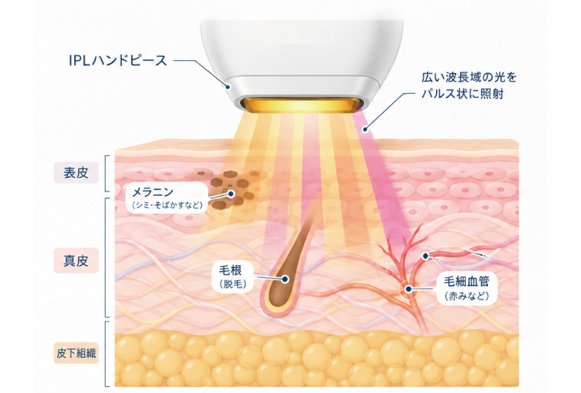 IPLとは