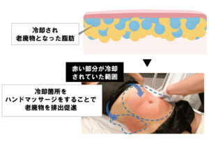 脂肪冷却機後のハンドマッサージ