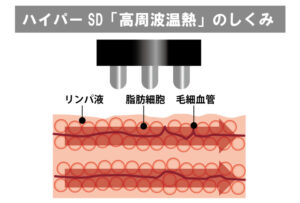 ハイパーSD「高周波温熱」の仕組み