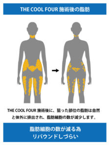 脂肪冷却はリバウンドしにくい