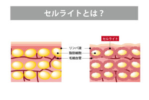 セルライトのしくみ