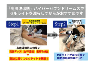 高周波温熱で代謝を高めてから脂肪冷却